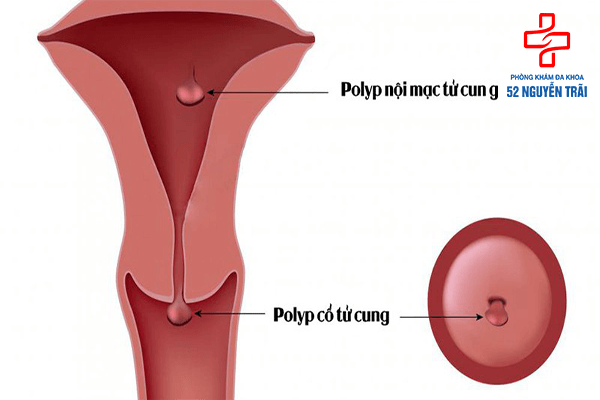 Polyp cổ tử cung là gì?