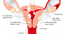 [Giải đáp] Bệnh u xơ tử cung là gì: Biểu hiện, biến chứng và cách điều trị hiệu quả