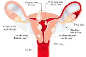 [Giải đáp] Bệnh u xơ tử cung là gì: Biểu hiện, biến chứng và cách điều trị hiệu quả