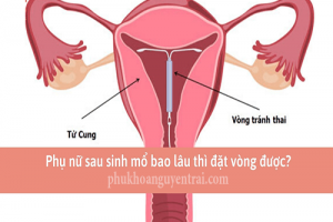 [BS Phạm Thị Minh Trang] Sinh mổ bao lâu thì đặt vòng được?