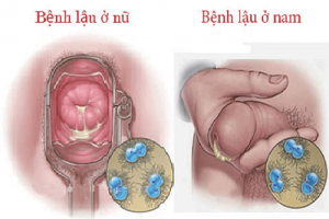 [Tổng hợp] Các triệu chứng của bệnh lậu cần khám ngay!