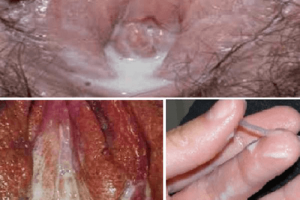 [ Cảnh báo ] Triệu chứng bệnh lậu ở nữ giới không nên chủ quan!