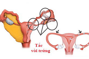 [Bác sĩ Sản khoa giải đáp] Tắc vòi trứng có kinh nguyệt không?